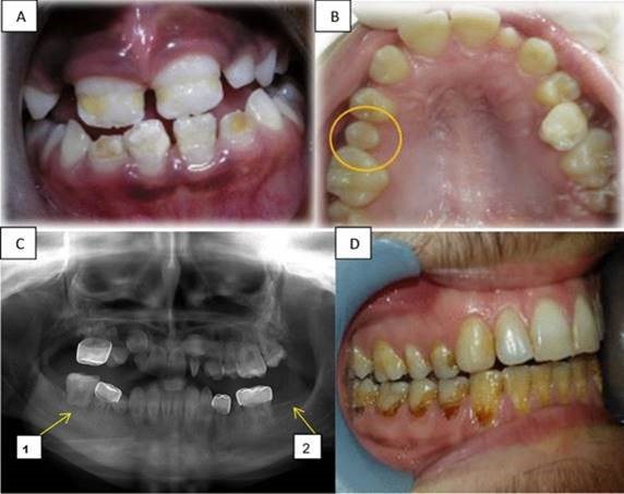 Efectos dentales a largo plazo. (A) Hipoplasia en los dientes frontales superiores e inferiores de una niña de 9 años, tratada por LLA a los 3,5 años de edad. (B) Microdoncia que muestra el segundo premolar superior derecho en una niña de 12 años, tratada por neuroblastoma a los 4 años. (C) Una radiografía panorámica de un niño de 12 años diagnosticado con linfoma de Burkitt a los 4 años, revelando: C1. Alteración del desarrollo radicular en el primer molar inferior derecho, C2. Hipodoncia del segundo molar inferior izquierdo. (D) Caries por radiación en un niño de 21 años tratado por tumor neuroectodérmico a los 14 años.